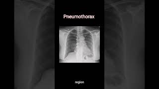 Diagnose Pneumothorax on chest Xray radiology cxr [upl. by Llevram622]