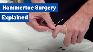 Hammertoe Surgery Explained by Dr Moore Using an Internal Pin [upl. by Onder]