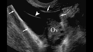 Gynaecology ultrasound cases15 case in 15 minutes sonopediauterine and adenaxal pathology [upl. by Eilraep440]