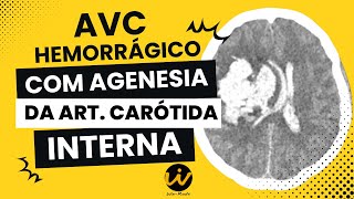 AVC Hemorrágico com Agenesia da Artéria Carótida Interna [upl. by Ferrell224]