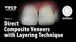 Direct Composite Veneers with Layering Technique using AMARIS  Operative Dentistry  VOCO GmbH [upl. by Llerahc]