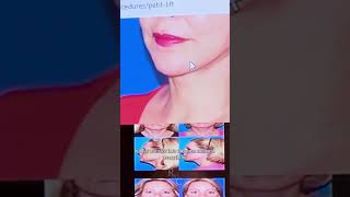 The Evolution of Face Lifts  Ranch amp Coast Plastic Surgery  Dr Paul E Chasan MD FACS [upl. by Nitnelav]