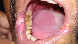 Leukoplakia signs and symptoms [upl. by Eugenius]