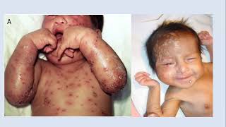 Lecture 205 Dermatoses of the Neonates Part3 Rook 10th ed Ch114 [upl. by Repard38]