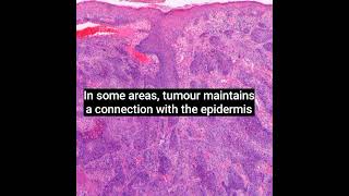 Histopathology of Porocarcinoma dermatopathology dermpath shorts [upl. by Granoff]