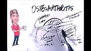 Osteoarthritis Explained Simply [upl. by Claudell547]