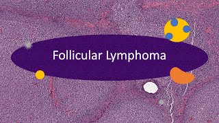 Follicular lymphoma in 15 minutes [upl. by Teresina420]