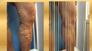 Varicose vein before and after Part 3  varicose vein treatment varicose surgery [upl. by Ettereve783]