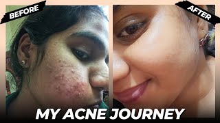 From Struggles to Clear Skin  My Acne Journey  Siri Ramala [upl. by Adnoel]