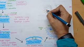 Atherosclerosis  Cause  pathology  Coronary Artery Disease in Hindi [upl. by Calvo462]