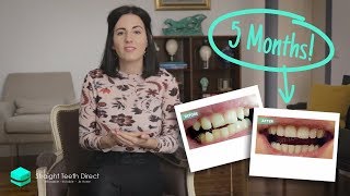 How long invisible aligners take to straighten teeth [upl. by Kirwin]