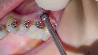 IZC screw Infra Zygomatic Crest TAD insertion of IZE mini screw IZC orthodontic mini implant [upl. by Akcirahs371]