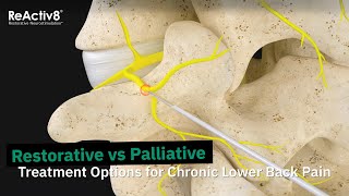 Restorative vs Palliative  Treatment Options for Chronic Lower Back Pain [upl. by Kling]