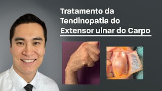 Tratamento da Tendinopatia do Extensor Ulnar do Carpo [upl. by Prisca]