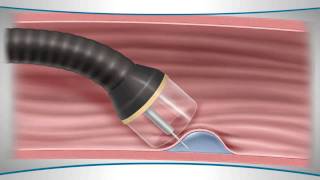 Learn About an Endoscopic Mucosal Resection [upl. by Bedell727]