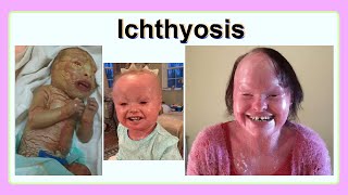 ichthyosis [upl. by Darwin558]