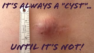 Skin lumpbump Its NOT always quotjust a cystlipomaquot Misdiagnosed Skin CancerSarcoma Mimic Cyst [upl. by Vernita]