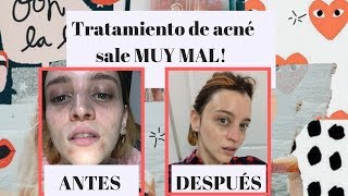 SKINCARE PARA ACNÉ MI EXPERIENCIA 7DÍASDE [upl. by Ahseym]