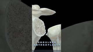 Shoulder Arthoplasty [upl. by Vernor]