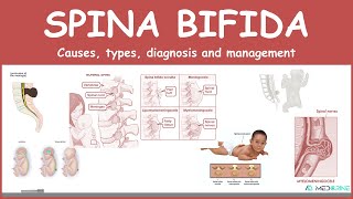 Spina bifida Types myelomeningocele meningocele occulta  causes symptoms diagnosis treatment [upl. by Astera54]