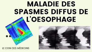 Maladie des spasmes diffus de loesophage [upl. by Ridglea]