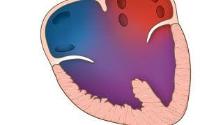 Hydrops fetalis because of cardiac anomaly  Atrioventricular septal defects AVSDs [upl. by Virginie]