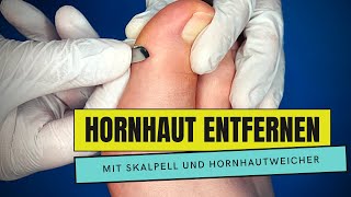 HORNHAUT ENTFERNEN mit Hornhautweicher und Skalpell  PODOLOGIE  MEDIZINISCHE FUSSPFLEGE [upl. by Riatsala57]