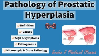 Pathology of Prostatic Hyperplasia  Hindi  Gross amp Microscopic Pathology  Pathogenesis [upl. by Adnalahs373]