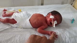 7 months pregnancy baby delivered premature baby born premature baby delivery [upl. by Inasah580]