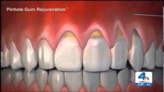 Reverse Receding Gums  Pinhole Gum Rejuvenation [upl. by Nalliuq]