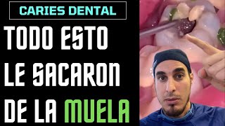 ¿Qué es todo esto que le sale de un AGUJERO en la MUELA  CARIES DENTAL [upl. by Shaylyn]