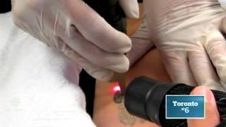 Dr Sean Rice  Picosure Tattoo Removal  CBC News [upl. by Annaerb447]