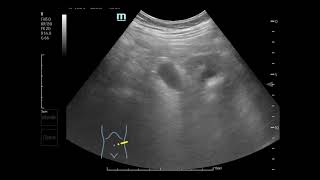 Left ureteral stones with obstructive uropathy [upl. by Asyle]