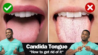 How To Fix A CANDIDA Yeast Overgrowth  Including Best Antifungal Herbs [upl. by Joella]