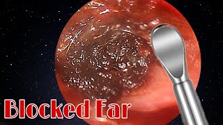 BIGGEST Ear Wax Difficult Removal  EP3  Doctor Anh [upl. by Romeo]