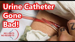 Urinary CATHETER PROBLEMS  Heart Surgery Gone Bad amp Problem with Catheter [upl. by Winograd330]