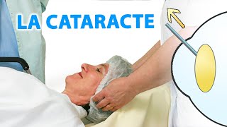 La cataracte expliquée par Dr Stopek [upl. by Milford]