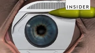 How LASIK Eye Surgery Is Performed [upl. by Hibbert]