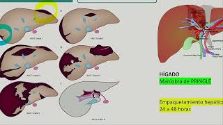 III Trauma Hepatico Esplenico y Pancreatico [upl. by Airamat]