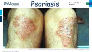 Dermatologie ─ Psoriasis [upl. by Nnayrb]