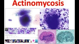 Actinomycosis Medschooltutorial [upl. by Plafker]