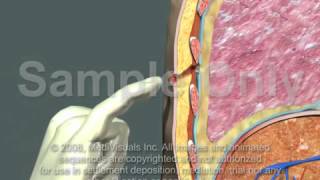 Thoracotomy  Normal Procedure [upl. by Eiuqcaj]