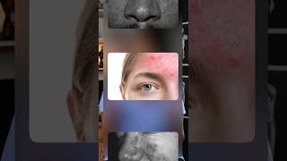 Acne Rosacea Explained acne rosacea [upl. by Ema]