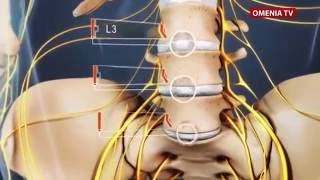 HERNIA DE DISC [upl. by Way]