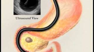 Endoscopic Ultrasound with Fine Needle Aspiration Biopsy [upl. by Obelia]