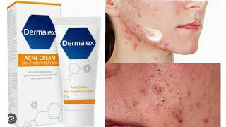 Dermalex Acne Treatment Cream [upl. by Ecirbaf908]