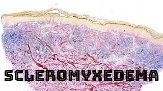 Scleromyxedema with colloidal iron stain pathology dermpath dermatology [upl. by Newcomer]