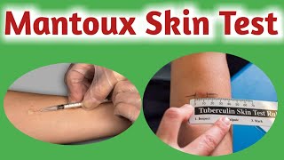 Mantoux test  Tuberculin skin test  Tuberculin test [upl. by Dazraf409]