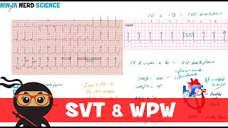 Rate and Rhythm  Supraventricular Tachycardia SVT and WolffParkinsonWhite WPW Syndrome [upl. by Lindo]