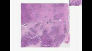 Histopathology Lymph nodeNodular sclerosis Hodgkin lymphom [upl. by Ardin]